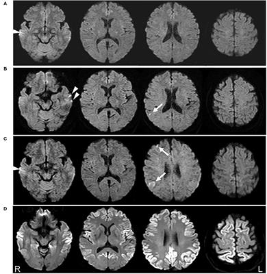 Case Report: Extremely Early Detection of Preclinical Magnetic Resonance Imaging Abnormality in Creutzfeldt–Jakob Disease With the V180I Mutation